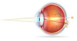 Cirugía Láser
