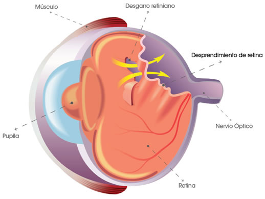 Cirugía Retina